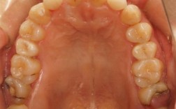 侧切牙存在间隙或扭转时，是应该先通过正畸矫正，还是直接做烤瓷牙修复更合适？