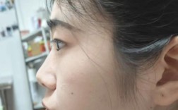 正畸牙改变侧脸图