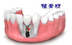 种牙的需要植骨么
