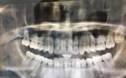 矫正中长智齿，会影响矫正效果吗？