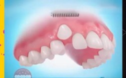 隐形矫正能改善虎牙吗？效果如何？