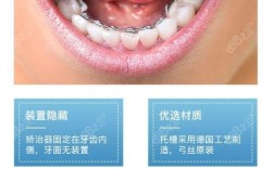 广州牙齿隐形正畸费用