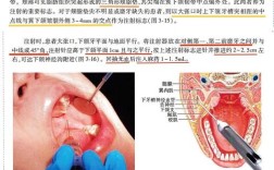 牙科打麻药是怎么打的？具体方法步骤是什么？