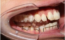 颞颌关节紊乱牙齿矫正