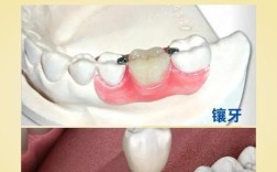 种牙还是活动义齿
