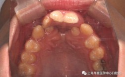 唇腭裂正颌正畸