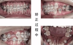 26岁矫正牙齿还来得及吗？
