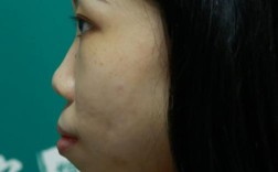 牙齿矫正后嘴巴突出