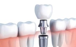 西安微创即刻种牙效果如何？即刻种牙安全吗？
