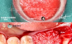 种牙填骨粉后出现该咋办？