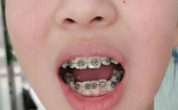 2025暑期正畸如何高效进行？时间安排与效果如何兼顾？