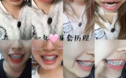 28岁矫正牙齿晚吗？效果会打折扣吗？