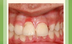 正畸会导致牙龈萎缩吗