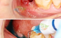 种植牙后有血痂正常吗？需注意哪些护理事项？