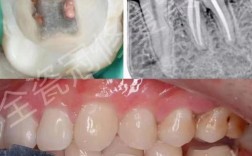 根管治疗后，这颗牙还能不能种牙呢？