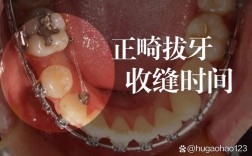 正畸拔牙收缝怎么收？图解步骤全解析，方法在这？