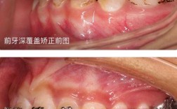 牙齿深覆盖矫正过程图包含哪些矫正关键步骤？
