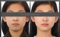 正畸中过小牙留缝该如何处理？具体操作方法有哪些？