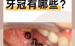 种牙用哪种冠好？材质、价格、美观度如何权衡？