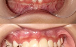 矫正完牙齿为什么会反弹？如何有效防止矫正效果反弹？