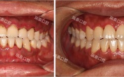 牙周病正畸综合治疗效果如何？