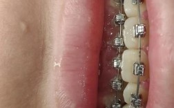 儿童牙齿矫正拔牙