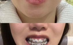 40岁矫正牙齿可行吗？年龄大矫正效果会受影响吗？