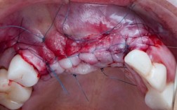 种牙感染的原因、症状及应对措施有哪些？
