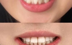 厦门隐形矫正牙齿效果好不好？