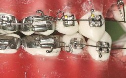 正畸治疗中停止曲的阻止作用具体指什么？其实现机制与临床应用效果如何？