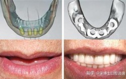 种植牙后多久能正常用牙咀嚼？