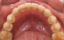 舌侧固定保持器正畸期间具体怎么护理？