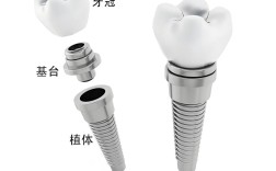 复合基台种植方法如何规范操作与选择？