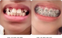 牙齿太歪了影响咀嚼和美观，能矫正吗？