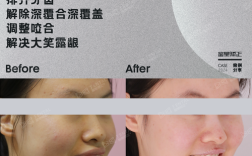 牙床突出的矫正方法有哪些？不同情况如何选择有效矫正方式？