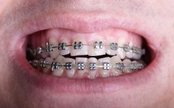 广州牙齿钢丝矫正效果如何？需要多久见效？