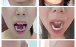 矫正牙齿前后脸型对比