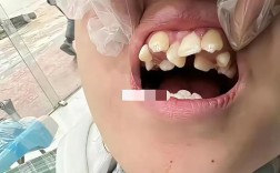 正畸期间晚上咬牙