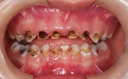 牙齿正畸出现虫牙