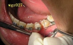 正畸结扎丝松动怎么办？会影响矫正效果吗？