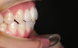 口腔正畸摄影45度