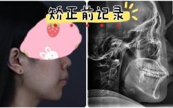 如何有效旋转牙齿？矫正牙齿的旋转方法有哪些？