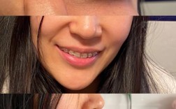 怀孕 牙齿正畸矫正