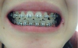 矫正牙齿钢丝松了