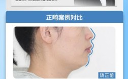 前牙覆合覆盖异常，正畸矫正需关注哪些关键问题？