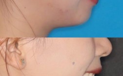 门牙牙缝2mm正畸能关闭吗？如何矫正？效果如何？