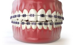 第一磨牙缺失患者正畸治疗需满足哪些关键条件？年龄、缺牙间隙及邻牙状态如何影响正畸方案选择？