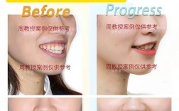 牙齿咬合关系矫正，哪些情况需做？效果如何？