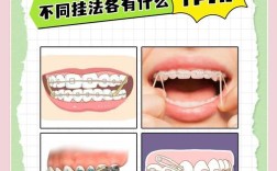 正畸橡皮链怎么安装？详细方法与操作技巧全解析