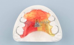 低阻力牙齿正畸器